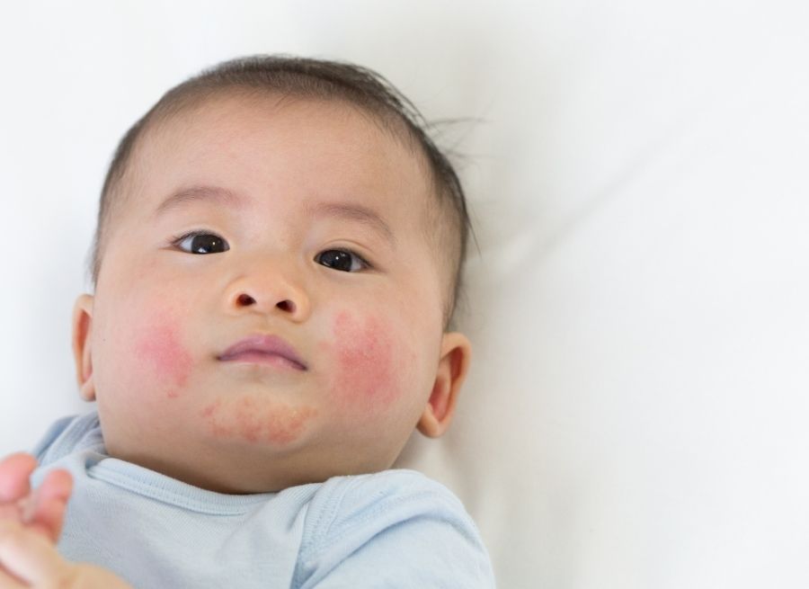 common baby rashes and when to call a doctor