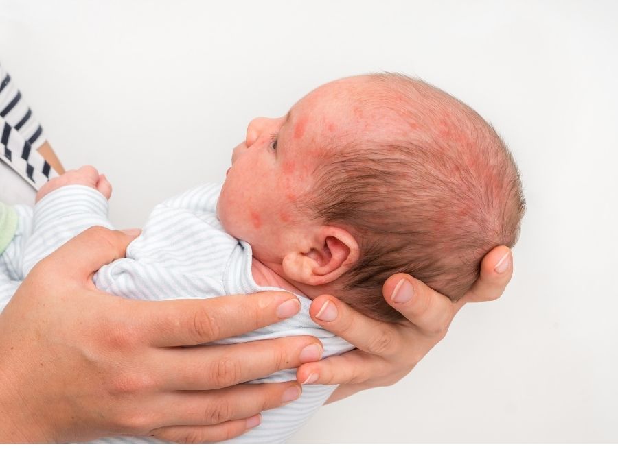 common baby rashes and when to call a doctor